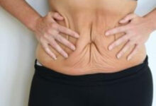 How Long Do Tummy Tuck Results Last