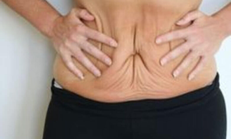 How Long Do Tummy Tuck Results Last